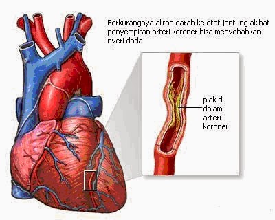 obat penyakit jantung koroner herbal