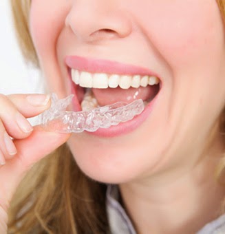 Niềng răng Invisalign thường dao động trong khoảng 6000 cho tới 8000 USD