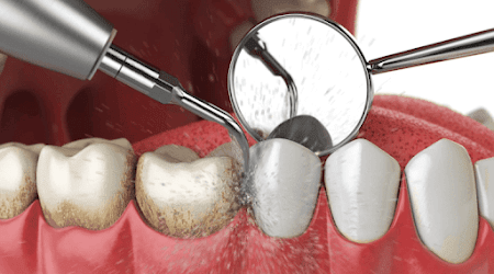 professional teeth cleanings