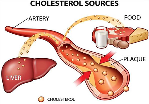 Sử dụng nhiều thực phẩm có nhiều Cholesterol là nguyên nhân hàng đầu dẫn tới bệnh gan nhiễm mỡ