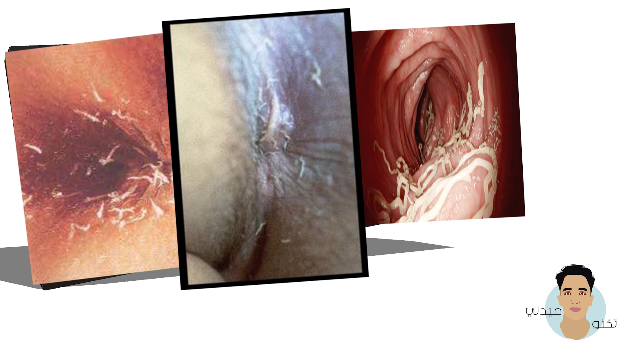 الدودة الدبوسية عند الكبار والاطفال-الأعراض والتشخيص والعلاج