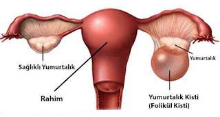 Yumurtalık Kisti Belirtileri