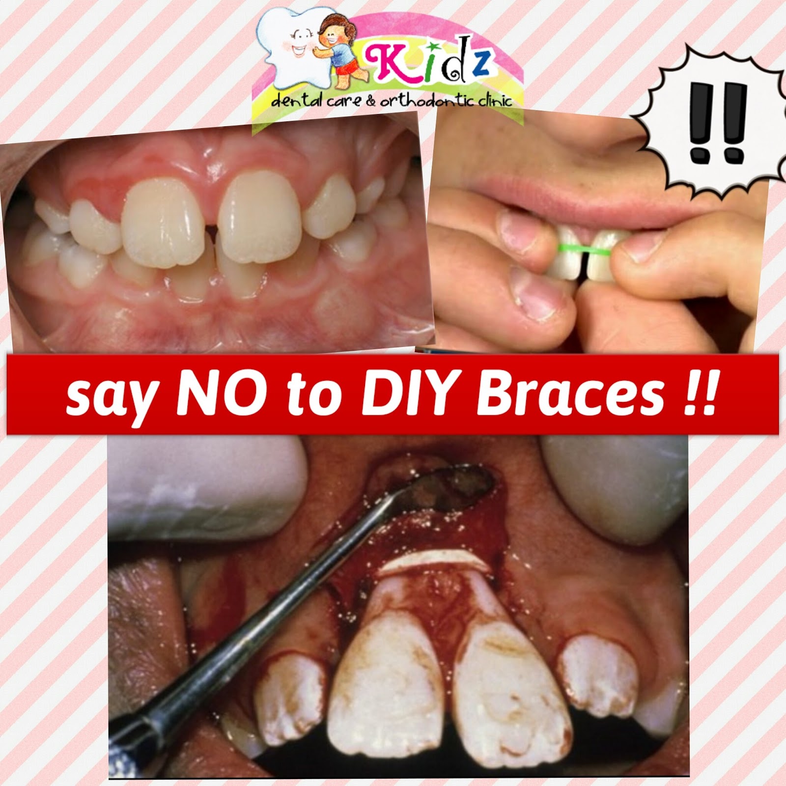 Say No to DIY Braces