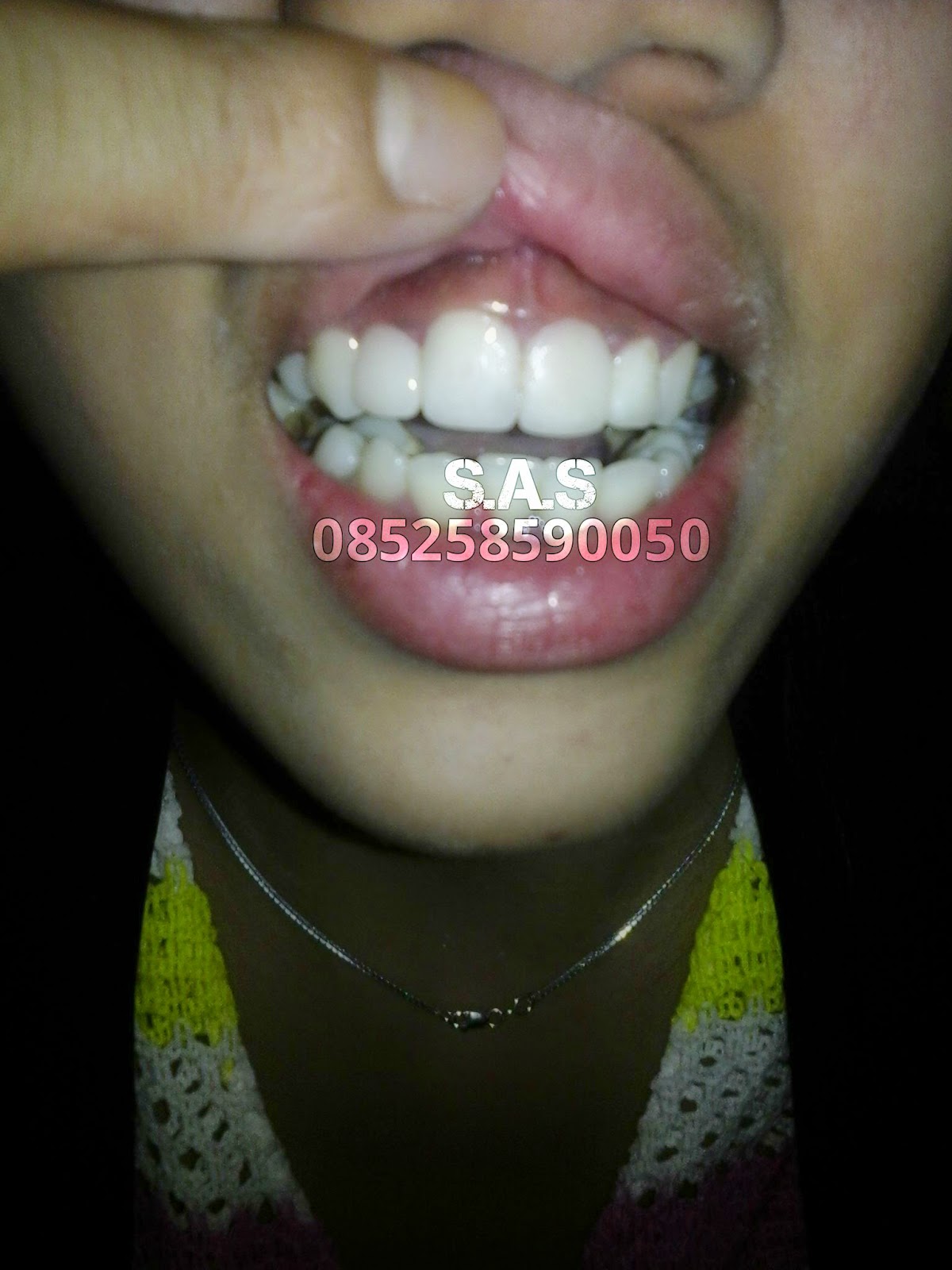 memasang tanpa cara behel kawat / Tanpa Tukang AHLI Instan Gigi Cara behel Cepat GIGI Kawat Gigi dan memasang tanpa cara behel kawat / Tanpa Tukang AHLI Instan Gigi Cara behel Cepat GIGI Kawat Gigi dan