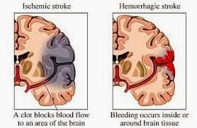 Obat Herbal Untuk Penyakit Stroke Ringan, Gejala dan Penyebabnya