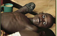 Penyakit Kolera gambar Penyakit Kolera