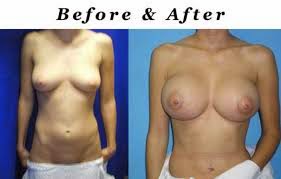 Breast Enhancement Surgery