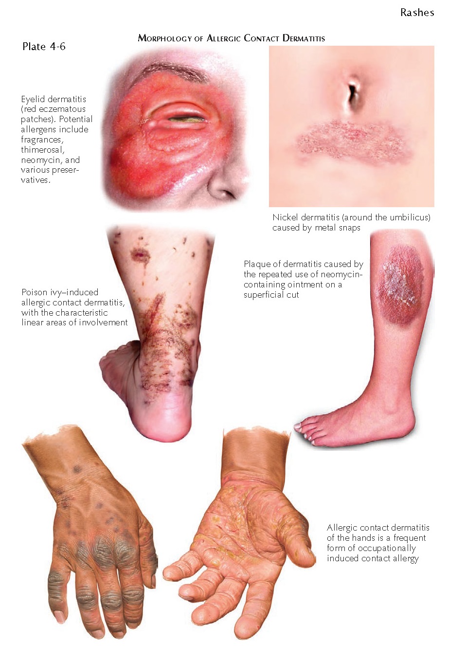 MORPHOLOGY OF ALLERGIC CONTACT DERMATITIS