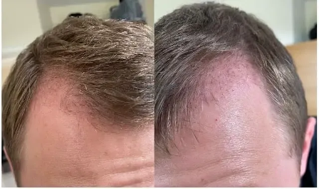 Insights into Post Hair Transplant Appearance