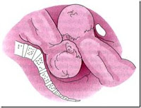 interlocking pada kehamilan kembar