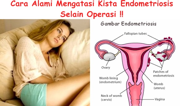 Obat Alternatif Untuk Kista Endometriosis Selain Operasi