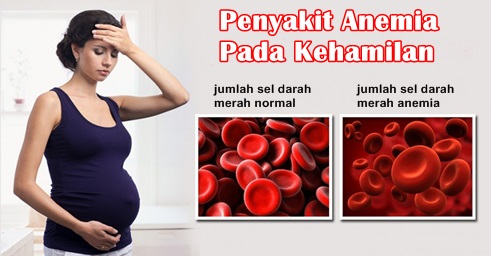 Anemia Saat Hamil 7 Bulan Dan Pengobatannya Yang Aman