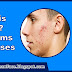 What is Acne Symptoms and Causes