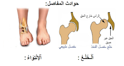 إيقاظ علمي س5: الحوادث الَّتي تصيب العظام و العضلات و المفاصل