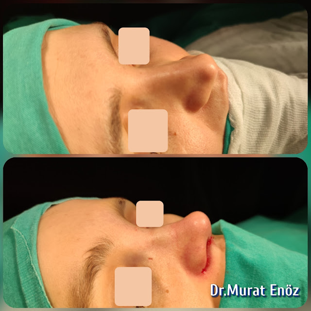 Augmentation rhinoplasty, Altering the nose size, Increasing the nose volume