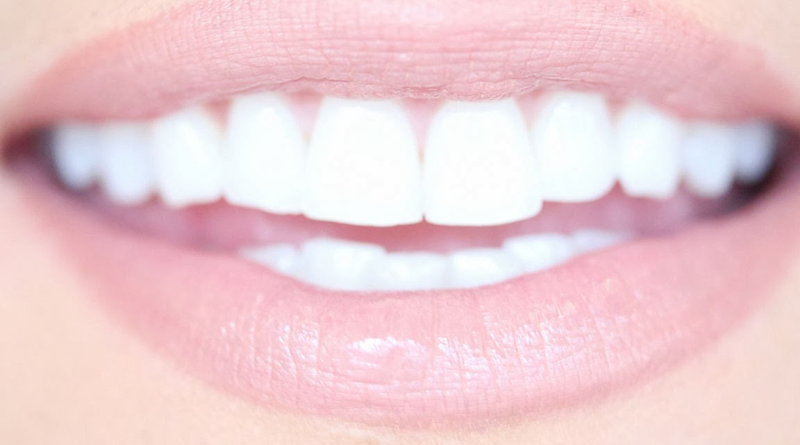 caritapremium: Beware of Kor teeth whitening at home
