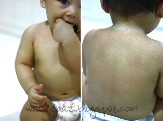 heat rashes in babies. heat rash baby.