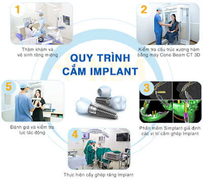 Trồng răng Implant mất bao lâu?