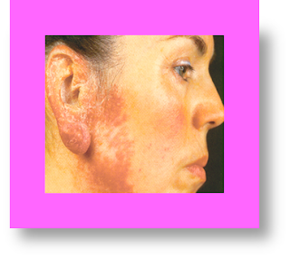 lupus vulgaris images lupus vulgaris treatment lupus vulgaris causes lupus vulgaris histopathology lupus vulgaris differential diagnosis lupus vulgaris medical definition lupus vulgaris medical term lupus vulgaris pictures