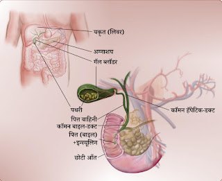 Pitt Ki Pathari पित्ताशय की पथरी