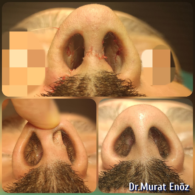 Caudal septum deviation dislocation