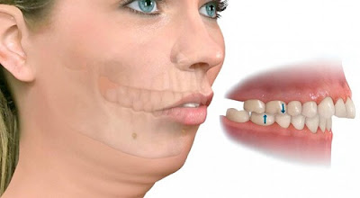 Giải phẫu răng hàm mặt – Đặc điểm nhận dạng hô hàm và hô răng  