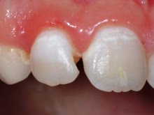 Qué causa las manchas blancas en los dientes (Odontología)
