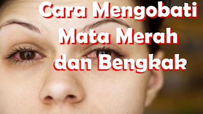 Penyebab dan Cara Mengatasi Mata Merah