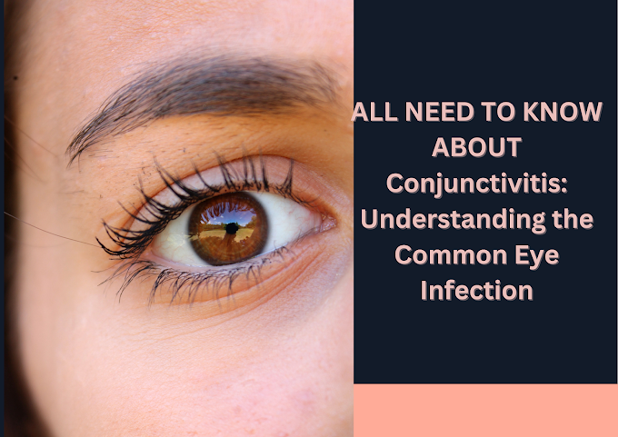Conjunctivitis: Understanding the Common Eye Infection