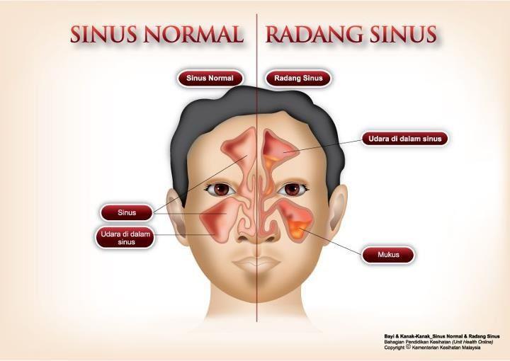 Radang Sinus (Resdung/ Sinusitis)  OMG! it's ninaa
