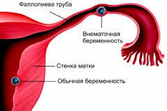  what causes brown discharge