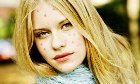 5 ways to Eliminate Smallpox Scars on the face