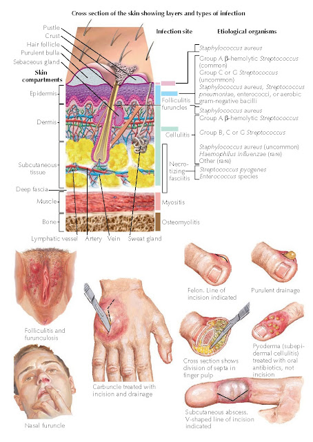 TYPES OF SKIN INFECTIONS