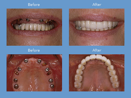 dental implant