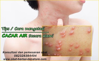 obat herpes kelamin,obat herpes zoster,obat cacar dompo,obat cacar air,obat herpes kemaluan,obat herpes tangan,obat herpes bibir,obat herpes badan