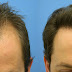 Cheap Hair Transplant - Hair Replacement Treatment and Techniques- INFO