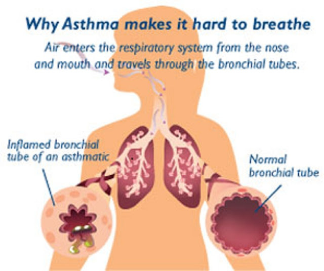 Asthma