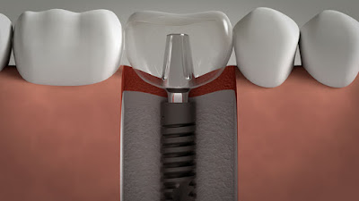 Quá trình cấy ghép Implant cho răng cửa