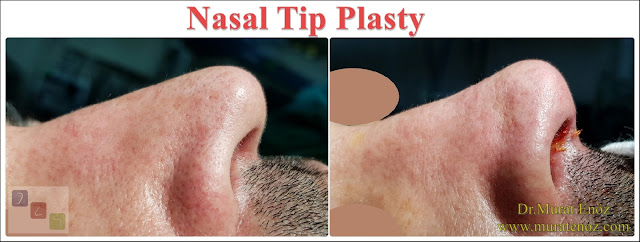 Nasal Tip Plasty in İstanbul - Nose Tip Reshaping in İstanbul - Nose Tip Surgery in İstanbul - Nose Tip Lifting in İstanbul - Droopy Nasal Tip Rhinoplasty - Droopy Nasal Tip Correction - Droopy Nasal Tip Surgery - Nasal Tip Ptosis - Droopy Tip Correction - Nose Tip Surgery