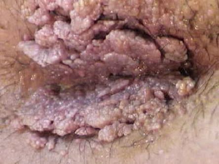 Gejala Human Papilloma Virus (Hpv)