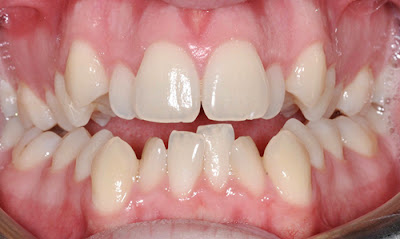 Tìm hiểu về phương pháp bọc sứ cho răng khấp khểnh