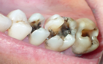 Nguyên nhân gây sâu răng sau khi niềng răng