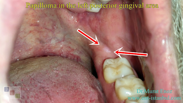 Papilloma in the left posterior gingival area