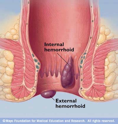 pengobatan hemoroid 