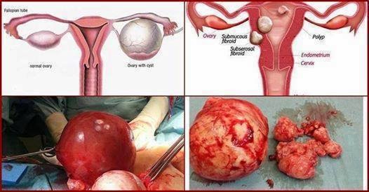 Cerita Anak-anak Ibu: MAKANAN YANG AKTIFKAN CYST dan BIOSELEZA