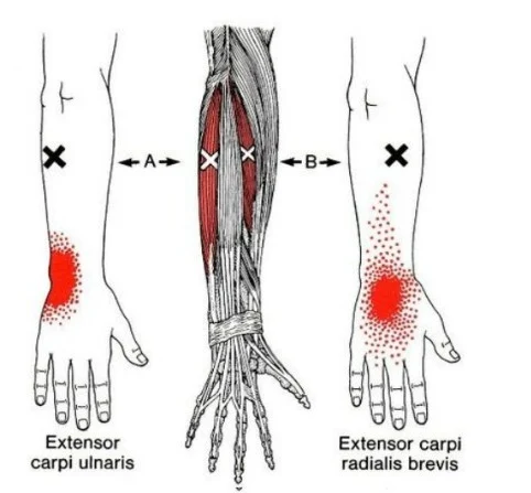 Antebrazo y muñeca - extensor cubital del carpo o cubital posterior - MCdevservices Spa