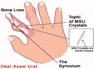 Obat Alami Menyembuhkan Penyakit Asam Urat, Asam Urat Usia 20, Harga Cek Asam Urat Di Prodia, Mengatasi Asam Urat Dengan Bahan Alami, Obat Untuk Penyakit Asam Urat.Com, Obat Asam Urat Herbal, Asam Urat Dan Fitnes, Obat Alami Utk Penyakit Asam Urat, Penyakit Asam Urat Obat Nya Apa, Bagaimana Cara Mengobati Asam Urat Secara Alami, Obat Alami Penyakit Rematik Dan Asam Urat, Lp Askep Asam Urat, Ciri Ciri Asam Urat Tinggi, Bagaimana Cara Mengobati Asam Urat Dengan Cepat, Obat Asam Urat Lutut, Obat Asam Urat Alami Paling Ampuh Tradisional, Ciri2 Asam Urat Naik, Obat Asam Urat Alami Dan Tradisional, Obat Apotik Penurun Asam Urat, Asam Urat Metabolisme, Bengkak Asam Urat Berapa Lama, Ciri Ciri Asam Urat Dan Obat Tradisionalnya, Pengobatan Asam Urat Dengan Lobak, Gejala Asam Urat Lutut, Tabel Gula Darah Kolesterol Dan Asam Urat, Obat Asam Urat Cair, Mengatasi Asam Urat Yang Tinggi, Garam Penyebab Asam Urat, Tanaman Herbal Obat Asam Urat Dan Kolesterol, Hasil Cek Asam Urat Lo 