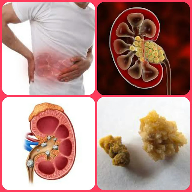 Suffering From Kidney Stones? Just Do This - And You Will Reap Good Benefits