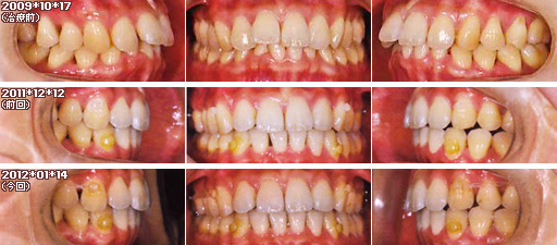 歯列矯正：定期検診その18