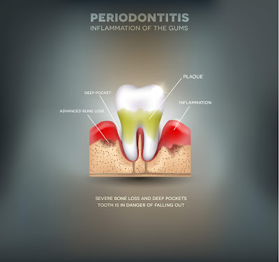 What Are Periodontal Emergencies And How To Handle Them?